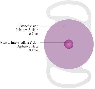 Quality of vision and outcomes after bilateral implantation of pseudo-non diffracting beam IOL